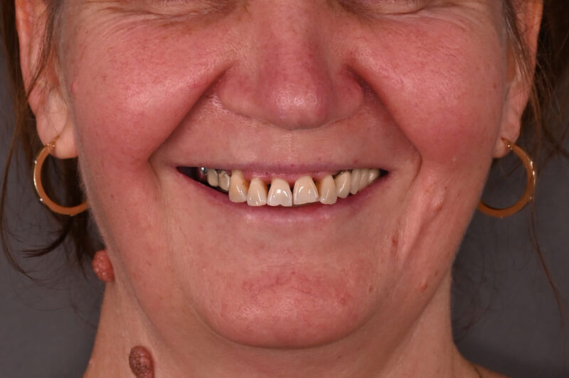 Zâmbet lateral dreapta_înainte